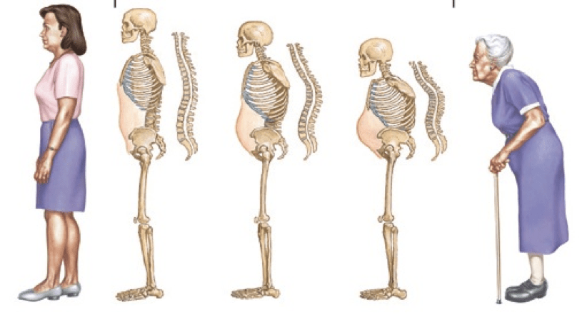 Vì sao nói khả năng gãy xương có liên quan đến lứa tuổi?